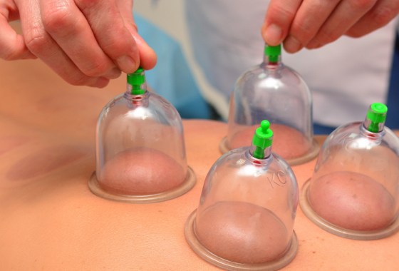 Health benefits of cupping therapy